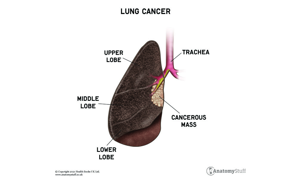 lung-cancer-smoking