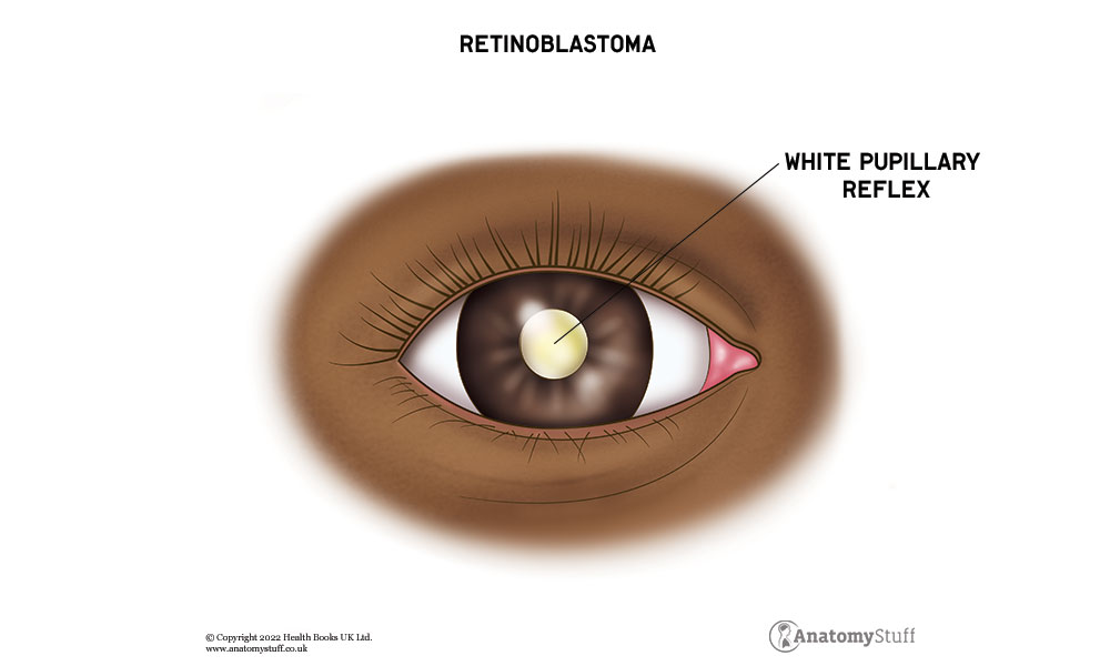 eye-cancer-retinoblastoma