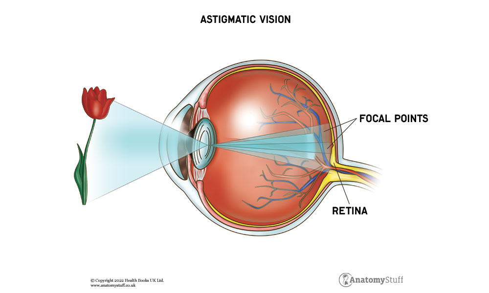 astigmatism-types-of-vision-blog
