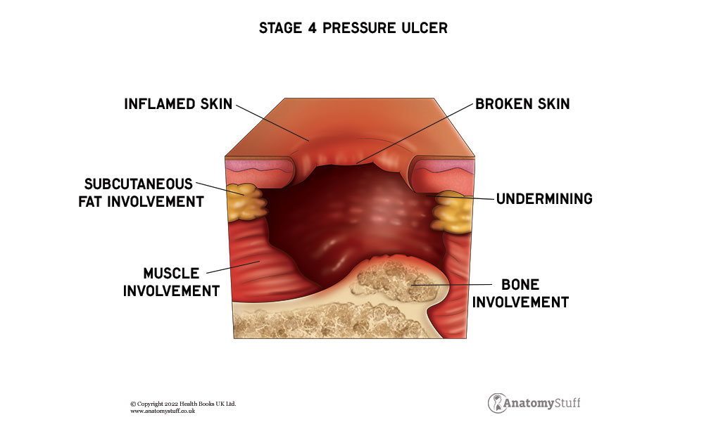 pressure ulcers stage 4 