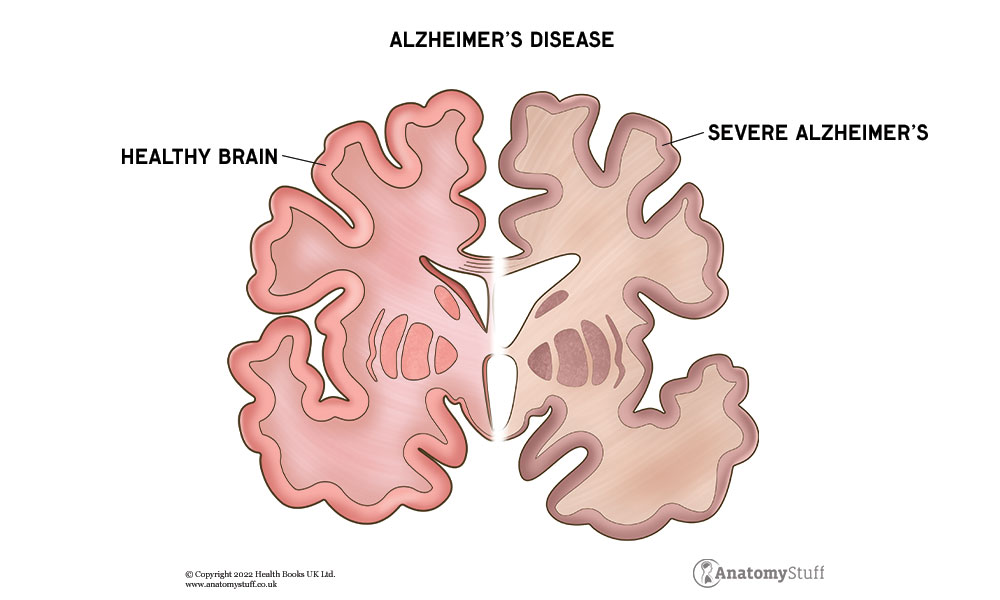 alzheimers-disease-dementia-brain