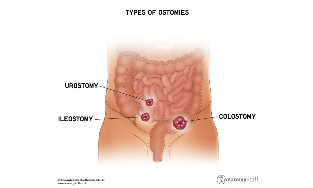 Urostomy Bag vs. Colostomy Bag: What's the Difference?
