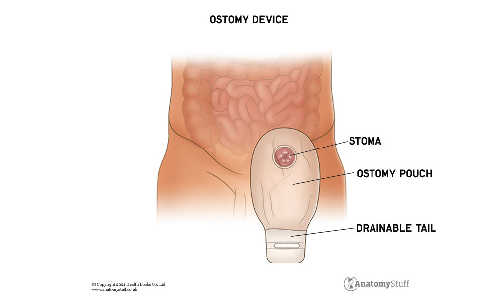 Ostomy pouches to manage your stoma simply and with ease